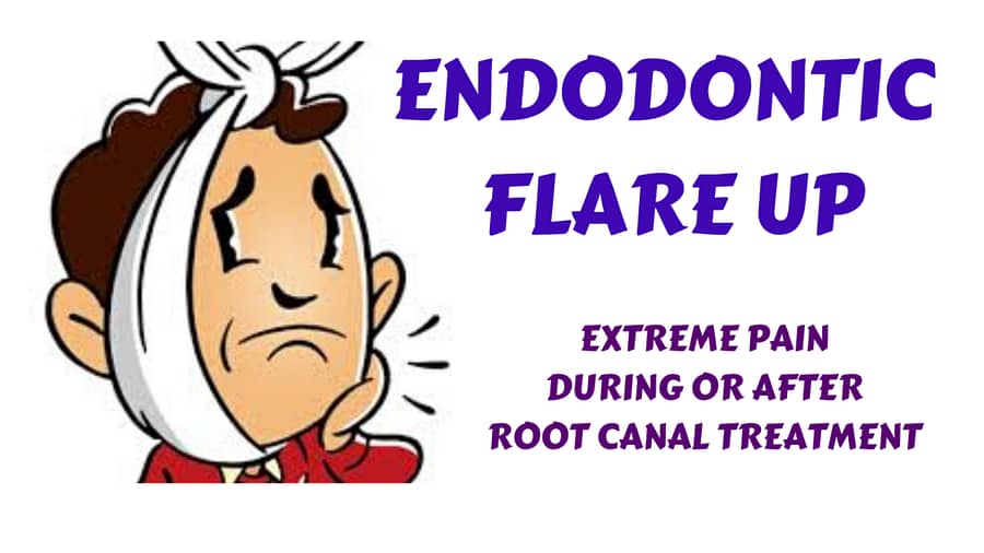 Endodontic Flare Up & Management – Extreme pain & swelling during & after root canal treatment(RCT)